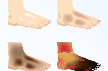 Stages of leg ischemia - gradual development of gangrene