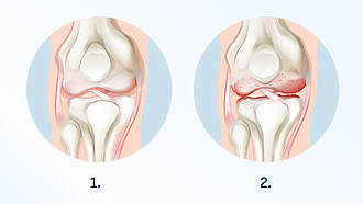Arthritis of the knee - damage to the joint can vary in extent