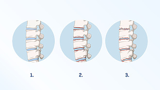 Spinal involvement in ankylosing spondylitis. Figure 1 shows a healthy spine. Figures 2 and 3 show the disability in ankylosing spondylitis.