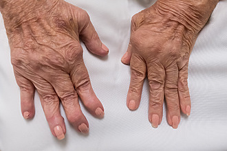 Arthritis of the joints of the hands - the affected joints need to be spared excessive strain