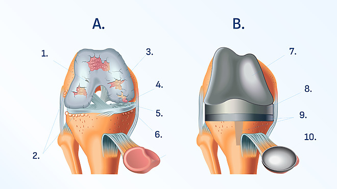Knee joint before and after surgery