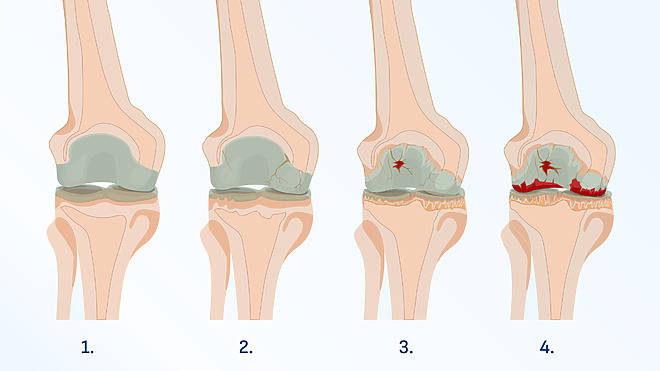 Stages of osteoarthritis of the knee