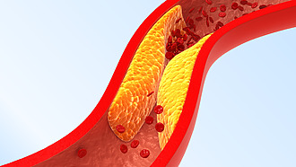 Atherosclerosis - fat particles accumulate in blood vessels
