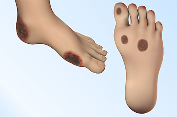 Při cukrovce jsou často na prstech 
 na nohou a na chodidlech.
