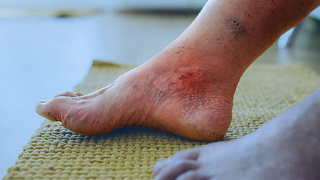 Diabetes symptoms on the skin - diabetic foot