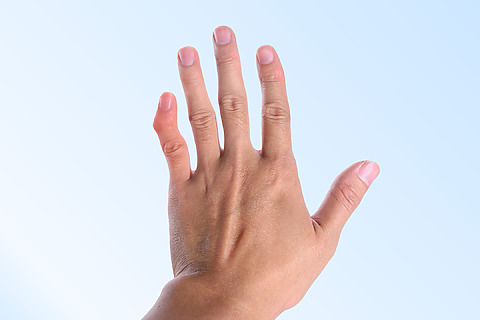 Finger deformity - one of the symptoms of a fracture