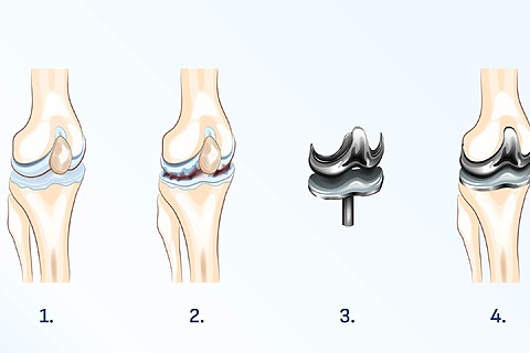 Endoprosthesis of a knee damaged by arthrosis