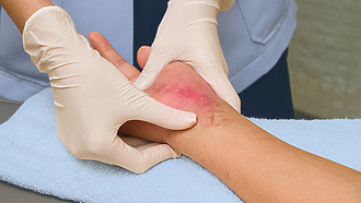 Postoperative wound healing: the condition of the wound, its colour and any signs of infection are checked