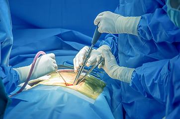 Sciatica surgery