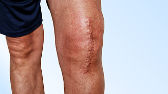 What scarring looks like after joint replacement