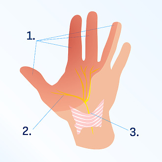 1. Compressed nerve and numb part of the hand shown in grey 2. The median nerve 3. The transverse carpal ligament