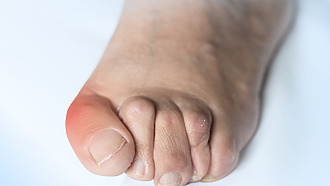 Hammer toes increase the risk of diabetic foot syndrome