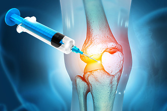 Arthritis of the knee - injections
