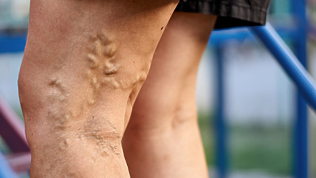 Varicose veins