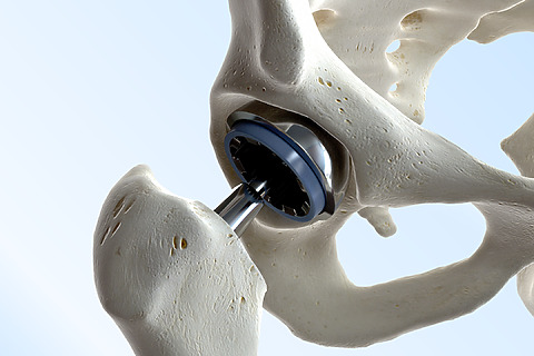 Endoprosthesis of the hip joint
