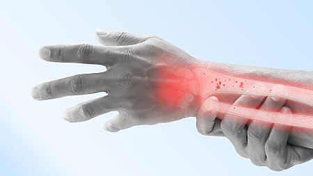 Osteoporosis - a common cause of fractures