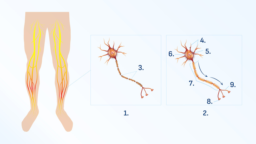 Difference between a healthy nerve cell
