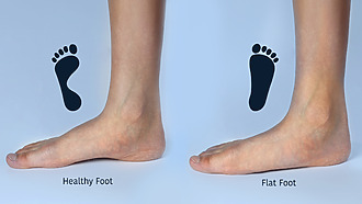 Ankle pain when running - flatfoot may be the cause