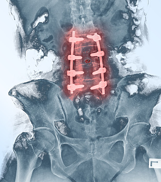 X-ray of the lumbar spine after surgery - reinforcement of the affected area with iron screws