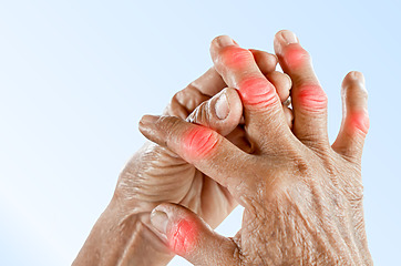 The knuckles on the fingers of the hand may be enlarged and deformed