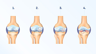 Osteoarthritis of the knee - stages of the disease