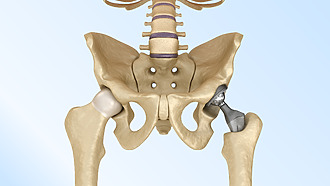 Artificial hip joint