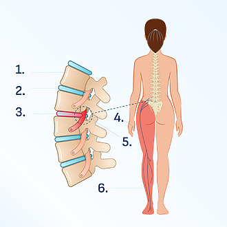 Herniated intervertebral disc in the lumbar spine