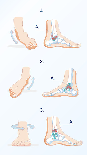 Ankle pain on the outside of the ankle occurs with ankle sprain
