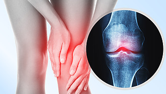Knee pain and swelling - typical symptoms of osteoarthritis
