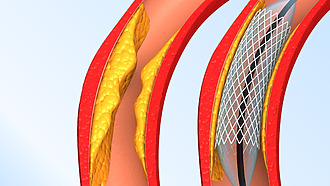 Ischemic disease of the lower limbs treatment - insertion of a stent into a narrowed vessel.